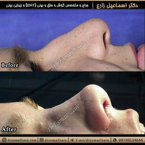 جراحی بینی استخوانی - دکتر زارع