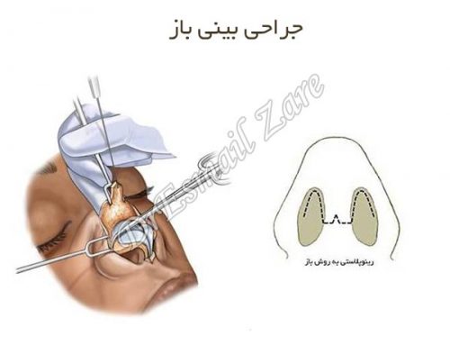 جراحی بینی باز + دکتر اسماعیل زارع