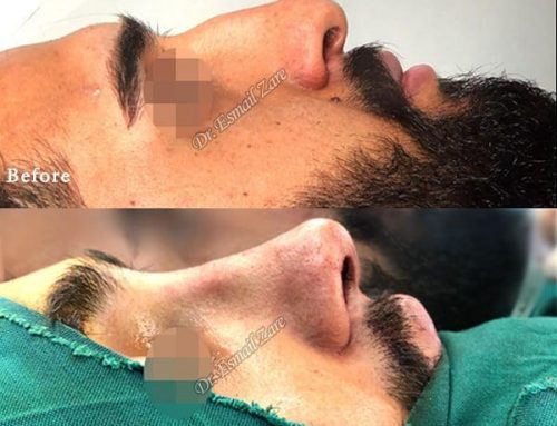 جراحی بینی در مردان