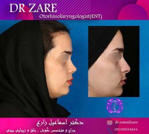 بهترین جراح بینی تهران - دکتر زارع