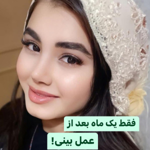 جراحی-بینی-109