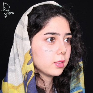 جراحی-بینی-41