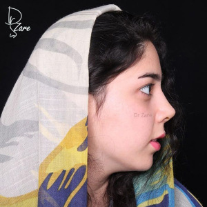 جراحی-بینی-43