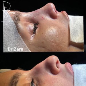 rhinoplasty-121