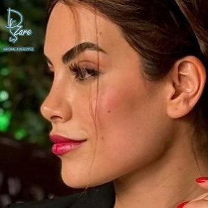 rhinoplasty-124