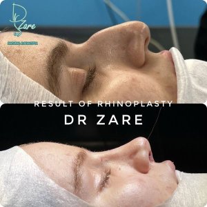 rhinoplasty-130