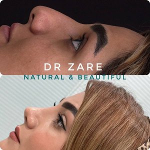 rhinoplasty-132