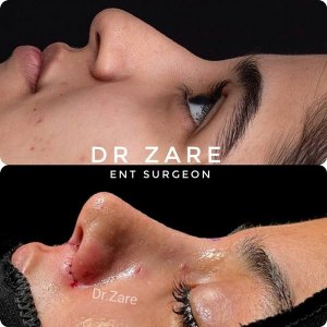rhinoplasty-133