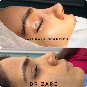 rhinoplasty-134