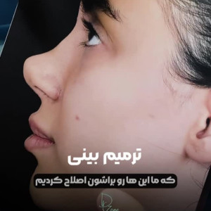 rhinoplasty-138