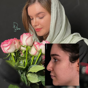 rhinoplasty-139