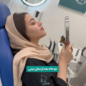 rhinoplasty-141