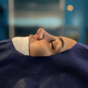 rhinoplasty-142