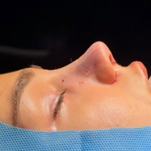 rhinoplasty-143