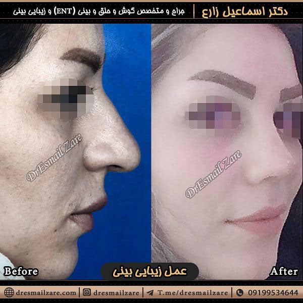 جراحی بینی گوشتی - دکتر اسماعیل زارع