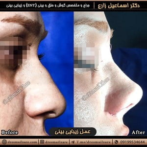 جراحی بینی در بانوان - دکتر زارع