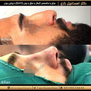 جراحی بینی در مردان - دکتر اسماعیل زارع