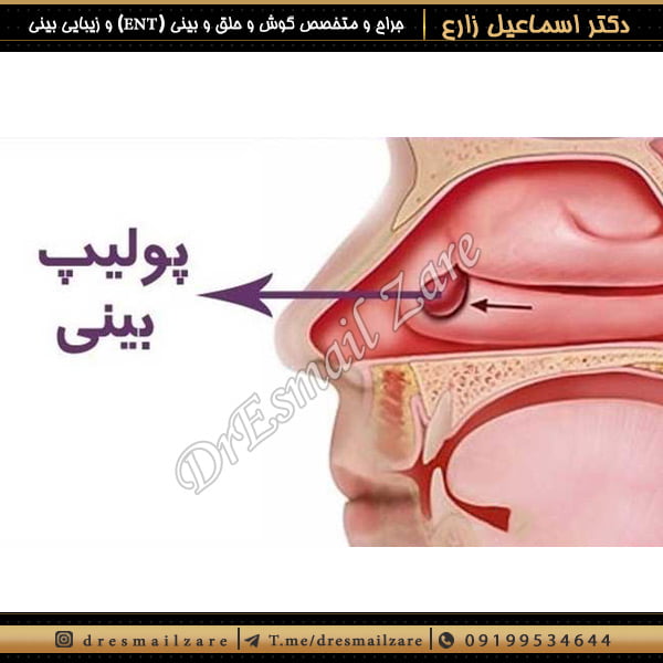 جراحی بینی