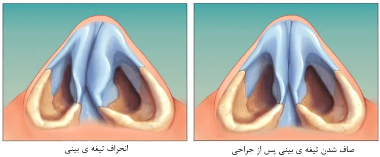 انحراف بینی - دکتر زارع 