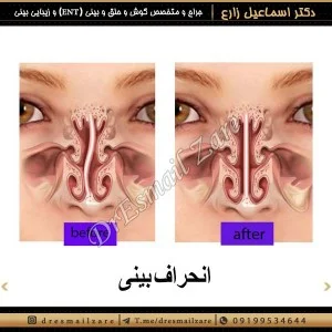 انحراف بینی - دکتر زارع