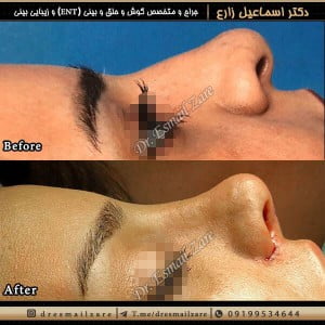 جراح بینی تهران - دکتر زارع