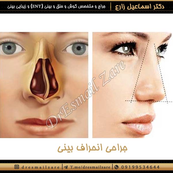 جراحی انحراف بینی