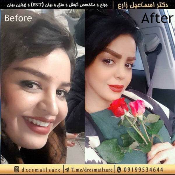 جراح بینی - دکتر زارع