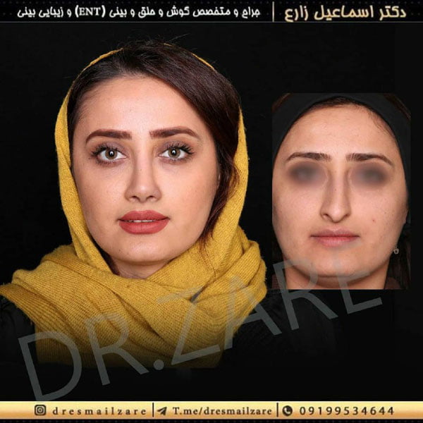 جراح بینی - دکتر زارع