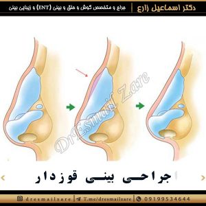 جراحی بینی قوزدار - دکتر زارع