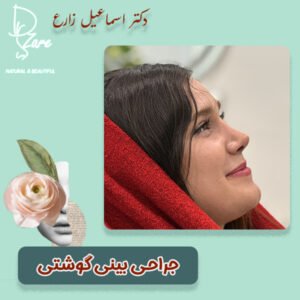 جراحی بینی گوشتی - دکتر اسماعیل زارع