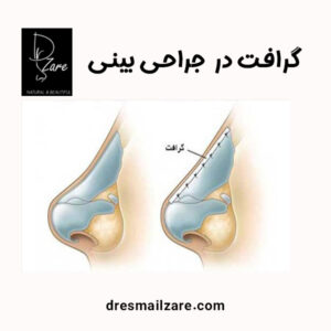 گرافت در جراحی بینی https://dresmailzare.com/