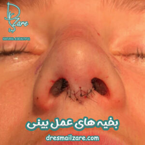 بخیه های عمل بینی