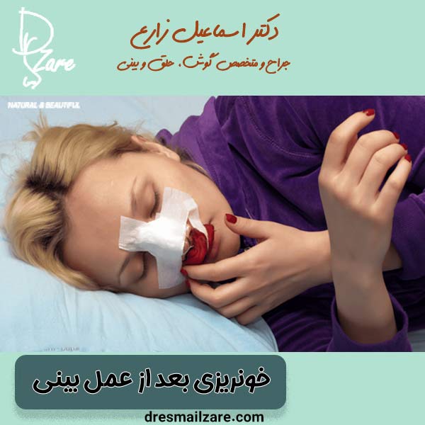 خونریزی بعد از عمل بینی - دکتر اسماعیل زارع