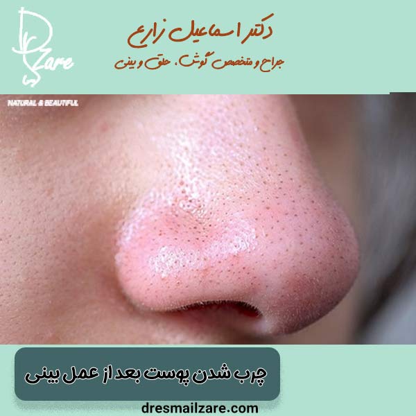 چرب شدن پوست بعد از عمل بینی