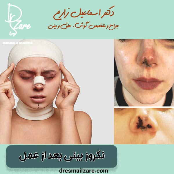 نکروز بینی بعد از عمل - دکتر اسماعیل زارع